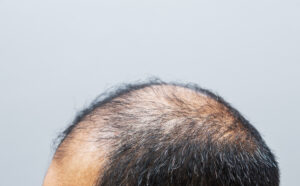 5 Reasons for Hair Loss