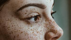 Freckles and Spots on The Skin