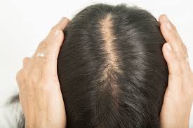 Healthy Diet Important for Preventing Hair Loss?