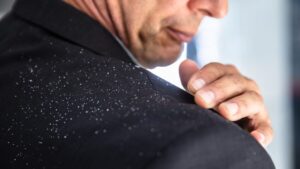 Dandruff: Causes and Remedies